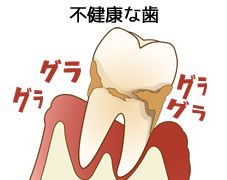 不健康な歯